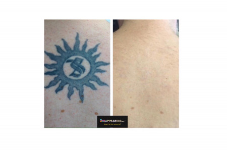 DISAPPEARING inc. Laser Tattoo Removal
