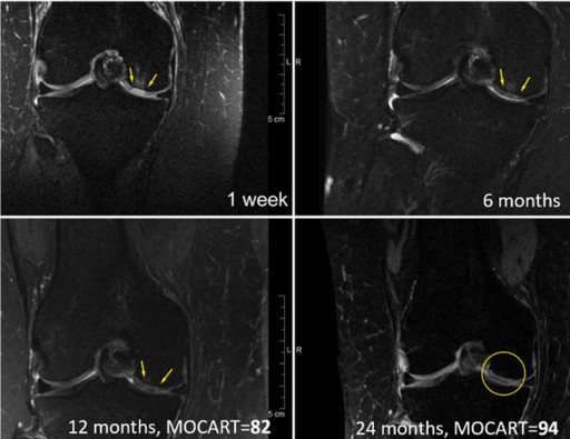 Regentis' GelrinC Demonstrates Breakthrough in Regenerating Native-Like Cartilage Structure in Knee Repair on MRI Results Confirmed Using a Validated, Regulator-Accepted Method