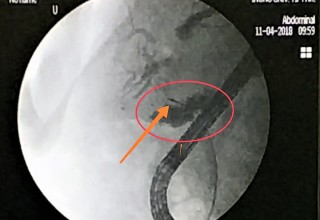 Microwave antenna in bile-duct