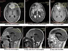 Malignant meningioma microwave ablation therapy