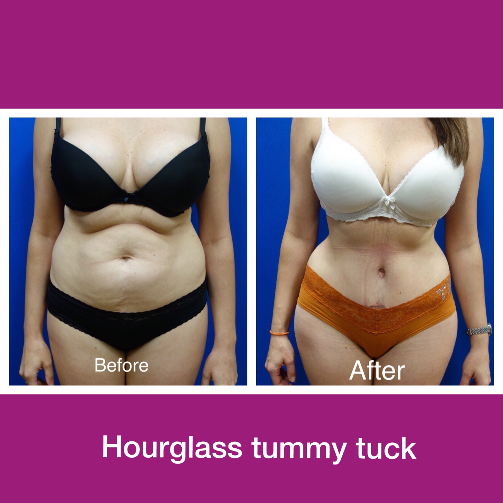 Hourglass Tummy Tuck vs. Regular Tummy Tuck