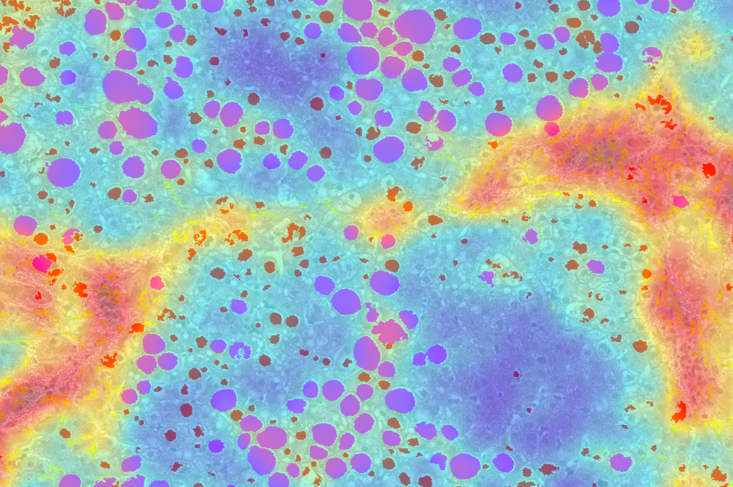 FIbroNest Analysis of a Liver Biopsy