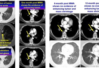 Lung tumor next to aorta treated with microwave ablation
