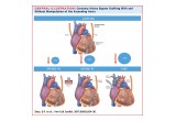 Central Illustration for Coronary Artery Bypass Grafting With and Without Manipulation of the Ascending Aorta