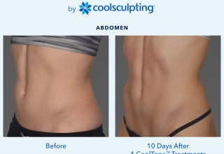 CoolTone from Allergan is FDA approved for muscle toning and firming.