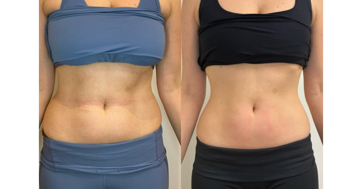 BODYWELLE Breaks Down How Morpheus8 Works to Tighten and Rejuvenate the Skin BODYWELLE Breaks Down How Morpheus8 Works to Tighten and Rejuvenate the Skin