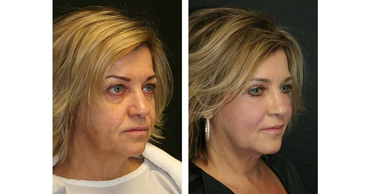Who Does the Best Eyelid Surgery in Florida?