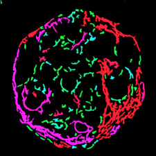 Human in-vitro 3D NASH tissue model Processed by FibroNest