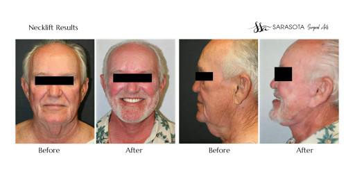 Who Does the Best Neck Lift in Florida?