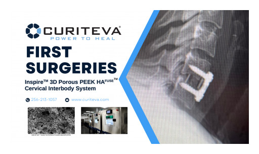 Curiteva Announces First Surgeries Performed With Novel 3D Printed Porous HA PEEK Technology