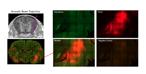 ClearPoint Neuro Enters into 10-year Focused Ultrasound Development Partnership with Sungkyunkwan University, South Korea, Further Expanding Our Drug Delivery Ecosystem and Global Footprint