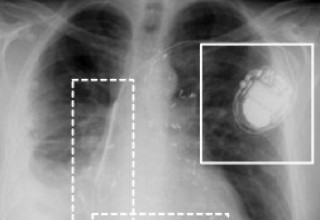 Pacemakers are Vulnerable to Cyberattack