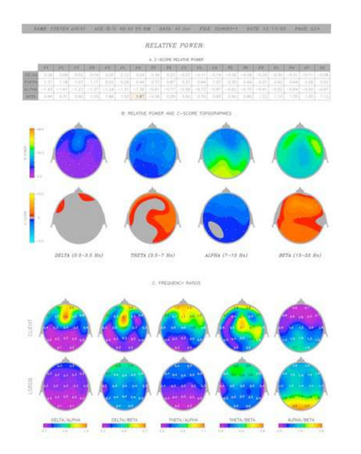 Hudspeth Pre- and Post-Brain Maps Spotlight a Measurement Path for EESystem™ Brain-State Research