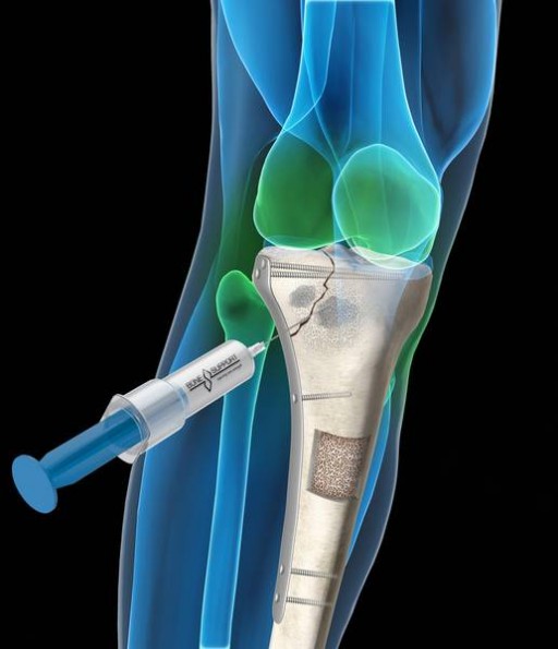Injectable Bone Graft Market Growth 2019 - 2025: QY Research