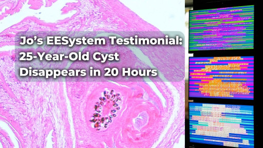 EESystem™ Testimonial: Jo’s 25-Year-Old Cyst Disappeared