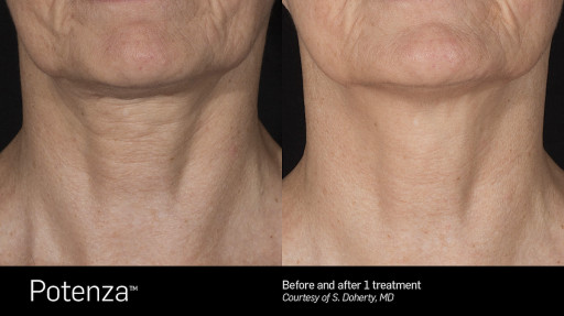 Dr. Anne Truitt and Dr. Barbara Martin Introduce Potenza RF Microneedling to San Diego