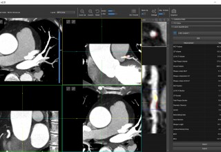 VoxelCloud Coronary CTA Image Analysis Sofware
