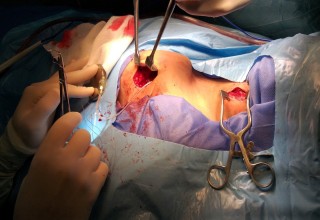 Surgery to insert vagus nerve stimulator (VNS)