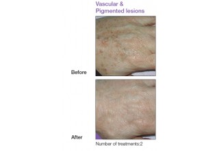 Pigmented and vascular lesions