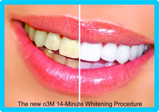 Major Cosmetic Teeth Whitening Breakthrough at DaVinci Teeth Whitening