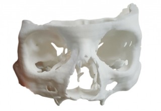 Maxilla and Zygomatic Bone Structure 3D-Printed Model