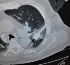 Lung tumor receiving microwave ablation treatment