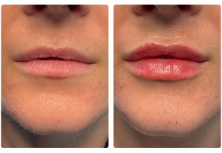 Before & After