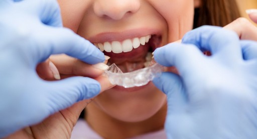 Dentist Dr. Alla Dorfman of All Smiles Dental Warns Patients About the Risks Associated With Direct-to-Consumer Orthodontics or 'Teledentistry' Such as At-Home Teeth Aligners
