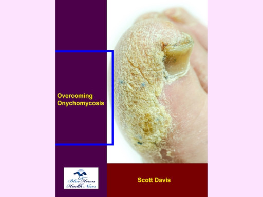 Overcoming Onychomycosis: 2025 Nail Health Guide
