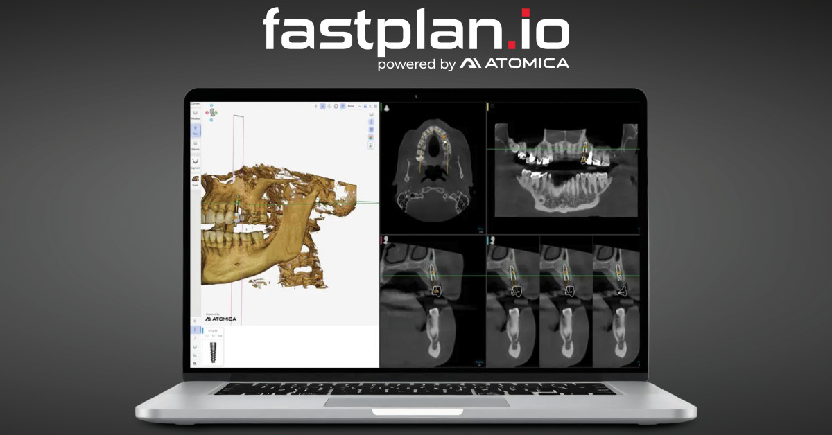 Glidewell Introduces fastplan.io(TM) Software for In-Office Guided Implant Planning and Surgical Design