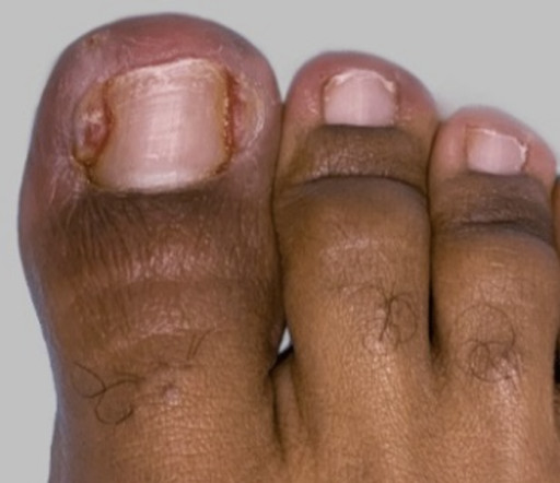 Ingrown Toenail: Causes, Symptoms and Treatment Information for Africans