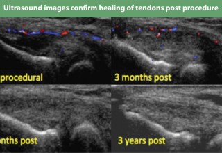 Ultrasound images confirm healing of tendons post procedure (Tenex Health TX)