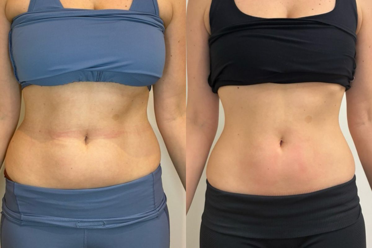 Morpheus8 on the abdomen