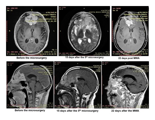 MedWaves AveCure® Microwave Ablation System Used to Successfully Treat Recurrent Brain Tumor Following Five Micro-Surgeries and Full Regiment of Radiation Therapy
