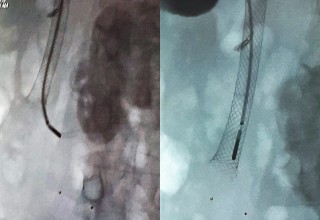 Microwave ablation in bile-duct stent