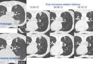Lung tumor biopsied and treated with microwave ablation