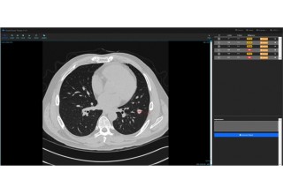 VoxelCloud Lung CT Image Management and Diagnosis Assistance Software