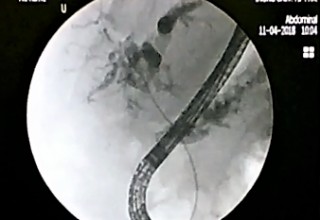 Microwave catheter in bile-duct