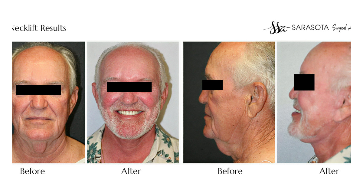 Who Does the Best Neck Lift in Florida?
