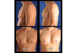 Pectoral Augmentation with Implants