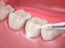 laser treatment for oral mucositis