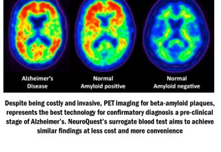 Designed to be an inexpensive, convenient surrogate test for costly positron emission tomography (PET) brain scans, the NeuroQuest blood test can potentially identify a pre-clinical stage of AD in a person years before the onset of noticeable symptoms.