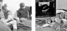 Microwave ablation of benign breast tumor and cyst 