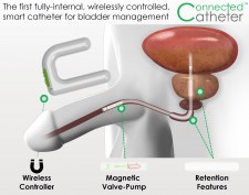 Connected Catheter 2P
