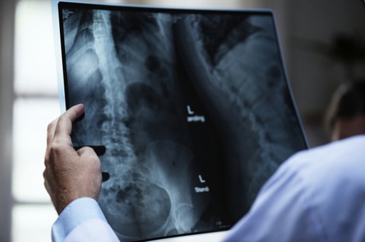Rockpoint Legal Funding: Spine Injury Surgeries - Time is of the Essence