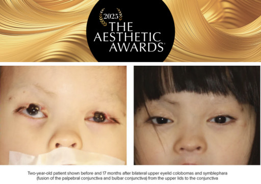 From Abandonment to Hope: Colorado Surgeon Restores Sight for Little Girl Born Without Eyelids