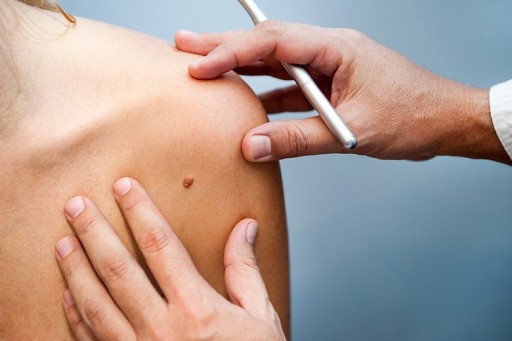 Massage Therapists Can Play an Important Role  in Early Skin Cancer Detection