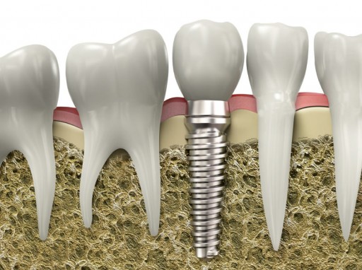 Patient's Ask the Sacramento Dentistry Group: Is It Easier to Eat With Implants?