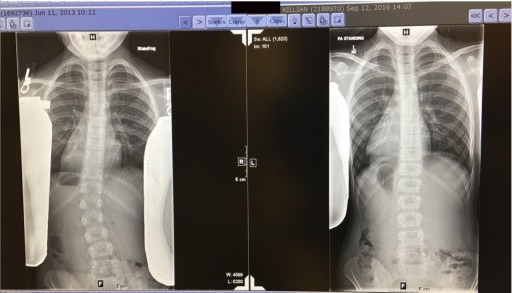 Scoliosis Reversed by REACT Physical Therapy With Non-Invasive, No-Brace Treatment: The Reavy Method