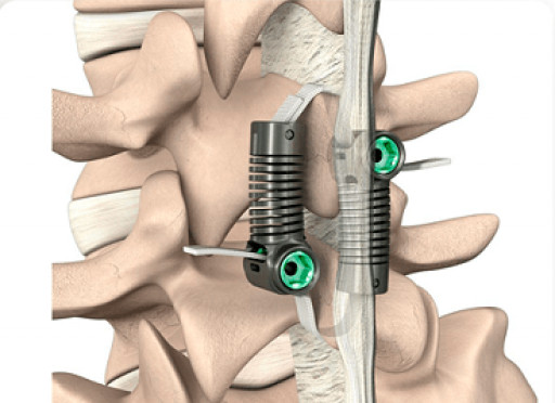 Empirical Spine Initiates PMA Submission Process for FDA Approval of Limiflex for Degenerative Spondylolisthesis